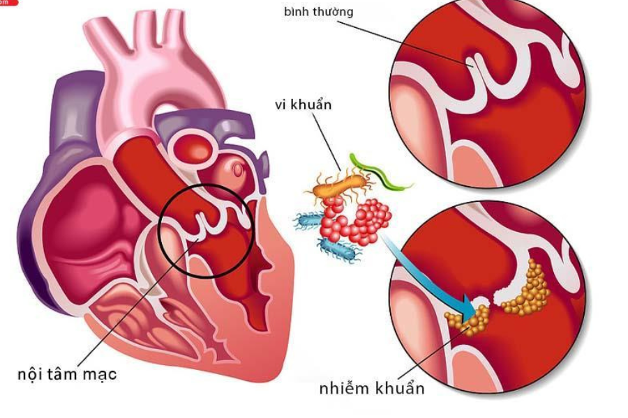 Vi trùng bám trên van hai lá làm lá van đóng không kín gây hở van