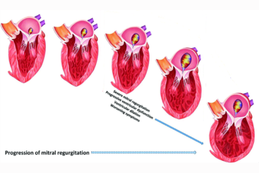 Dòng hở van hai lá càng nặng, buồng tim càng bị giãn và chức năng tim càng suy giảm