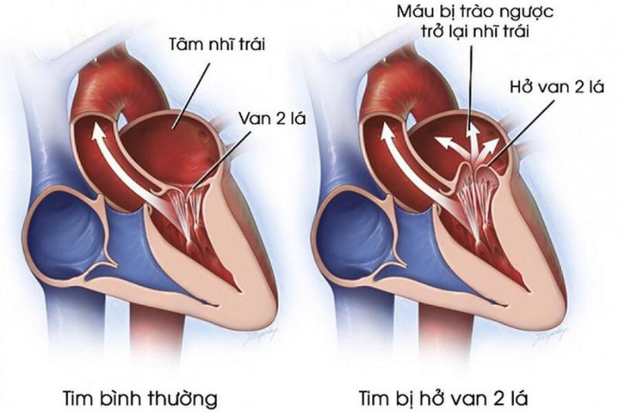 Hở van hai lá khiến máu bị thay đổi chiều dòng chảy, trào ngược một phần trở lại nhĩ trái.