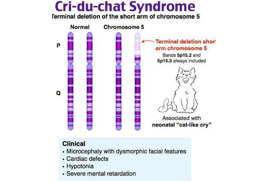 Hội chứng Cri du chat là một rối loạn di truyền hiếm gặp