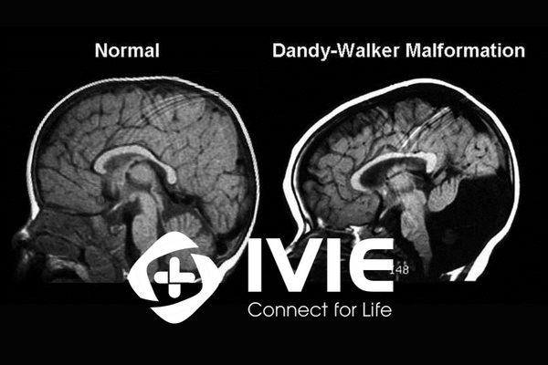 Hội chứng Dany-Walker: Nguyên nhân và triệu chứng