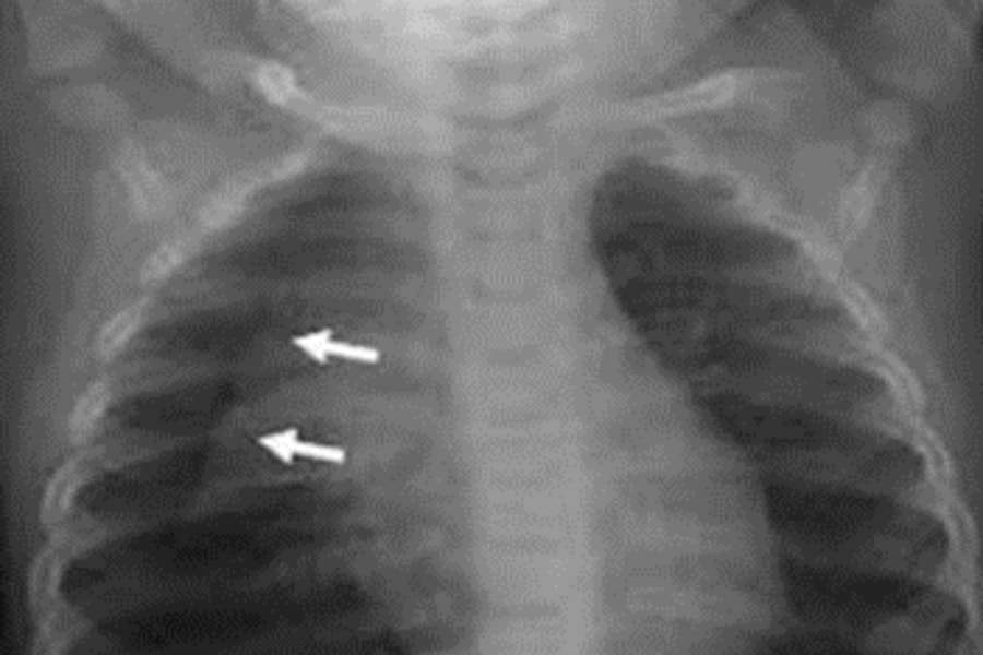 X-quang phổi nghiêng