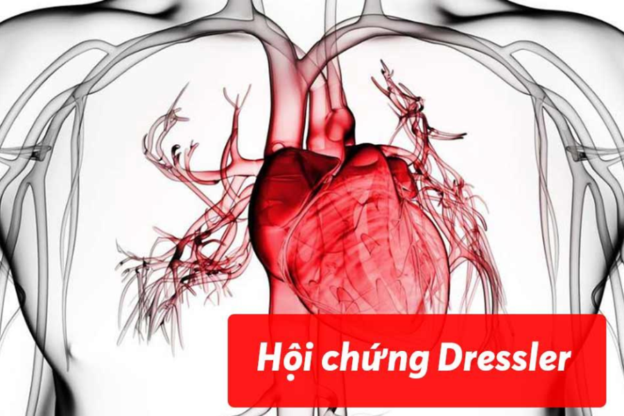 Hội chứng Dressler là nguyên nhân thường gặp gây viêm – tràn dịch màng ngoài tim sau nhồi máu cơ tim