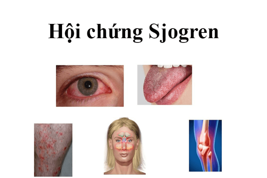 Hội chứng Sjogren là một hội chứng tự miễn, gây rối loạn tuyến ngoại tiết