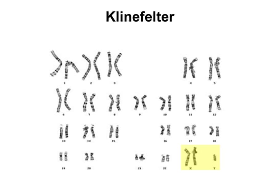 Hội chứng Klinefelter