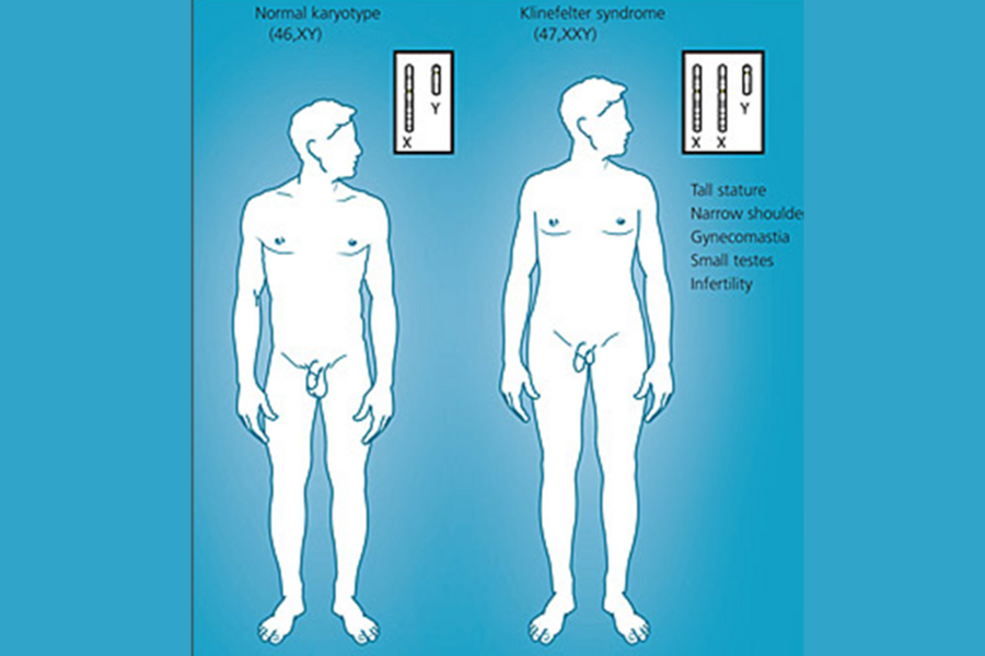 Hội chứng Klinefelter là do thừa nhiễm sắc thể X ở nam giới