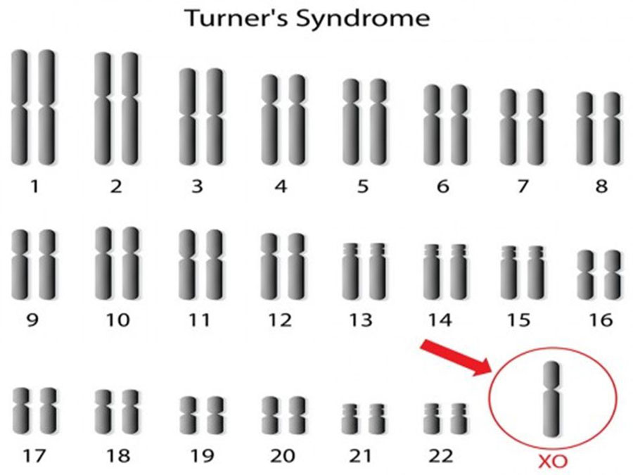 Đôi khi, tình trạng hội chứng Turner được phát hiện trước khi sinh.