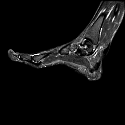 Chụp CT( chụp CLVT) vùng bàn tay/bàn chân không tiêm thuốc cản quang