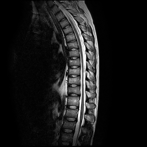 Chụp CT( chụp CLVT) cột sống ngực không tiêm thuốc cản quang