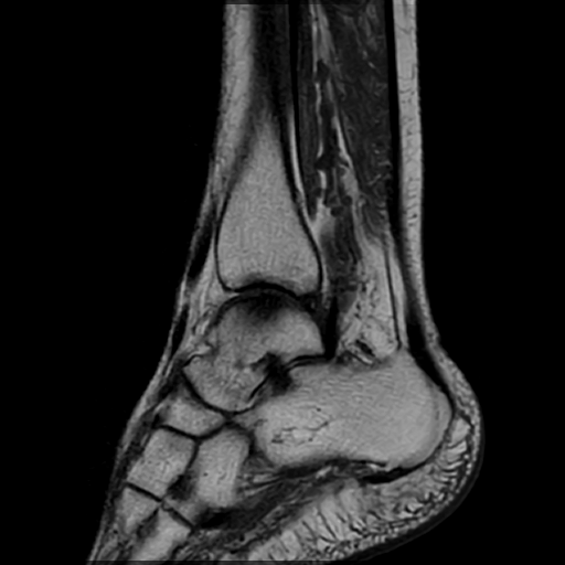 Chụp CT( chụp CLVT) khớp cổ tay/cổ chân không tiêm thuốc cản quang
