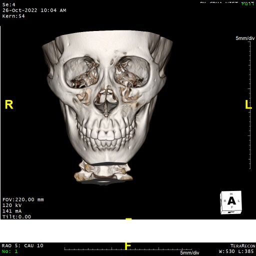 Chụp CT (chụp CLVT) hàm mặt không tiêm thuốc cản quang