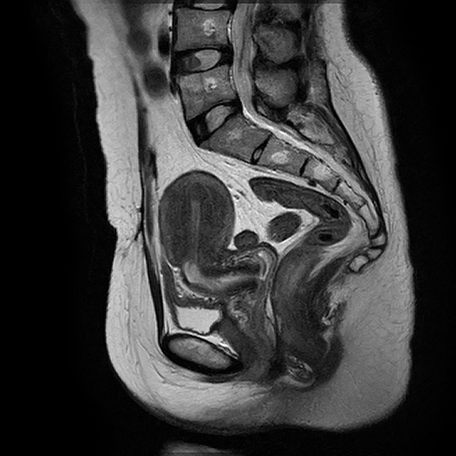 Chụp MRI xương cùng cụt không tiêm thuốc đối quang từ