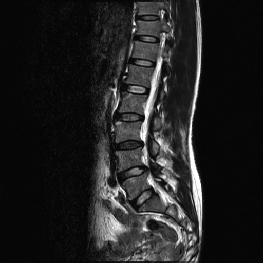 Chụp CT( chụp CLVT) vùng cùng cụt và khớp cùng chậu không tiêm thuốc cản quang