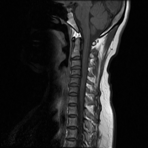 Chụp CT( chụp CLVT) cột sống cổ không tiêm thuốc cản quang
