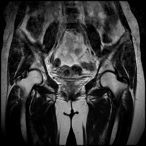 Chụp CT( chụp cắt lớp vi tính) khớp háng không tiêm thuốc cản quang