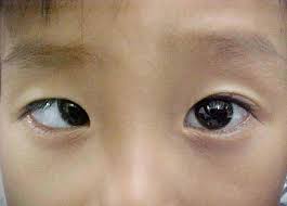 Mắt Lác Là Bệnh Gì? Tổng Hợp Những Điều Cần Biết Về Bệnh Mắt Lác