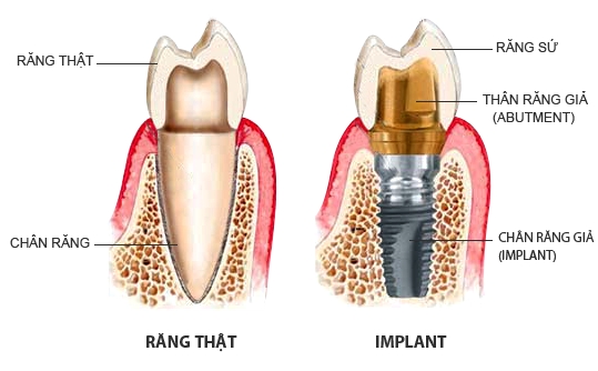 Tư vấn Cấy ghép răng Implant tại Nha khoa Phạm Dương