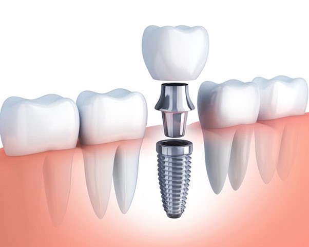 Khái quát về răng implant