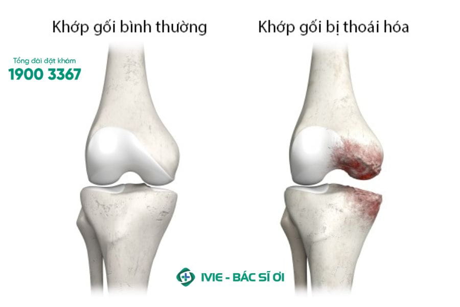 Thoái hóa khớp gối thường biểu hiện bằng cơn đau âm ỉ