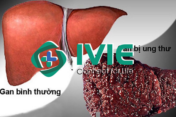 Khám ung bướu tại Bệnh viện Hữu nghị Việt Đức có tốt không ?