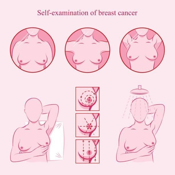 Tầm soát ung thư vú như thế nào?