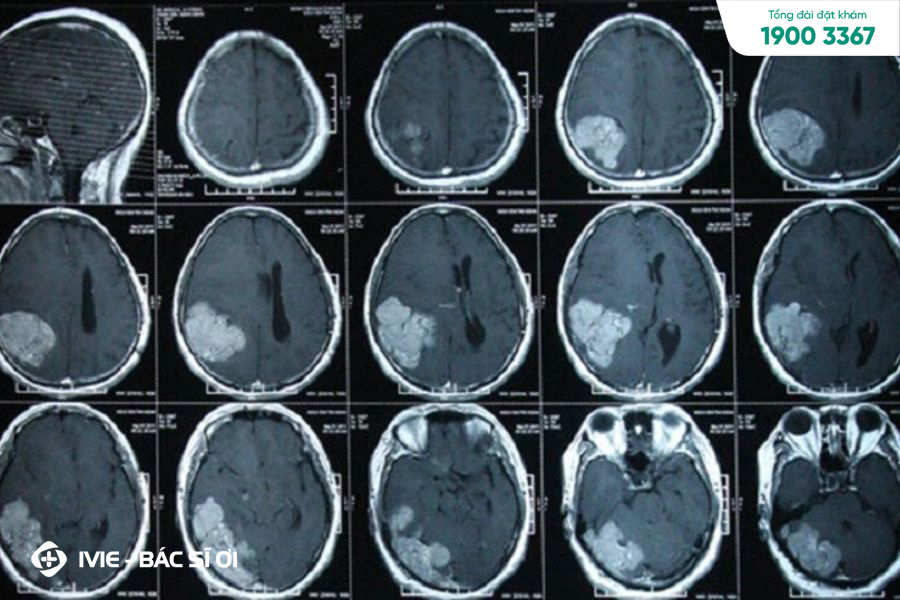 Chụp CT não là phương pháp để kiểm tra các vấn đề về não