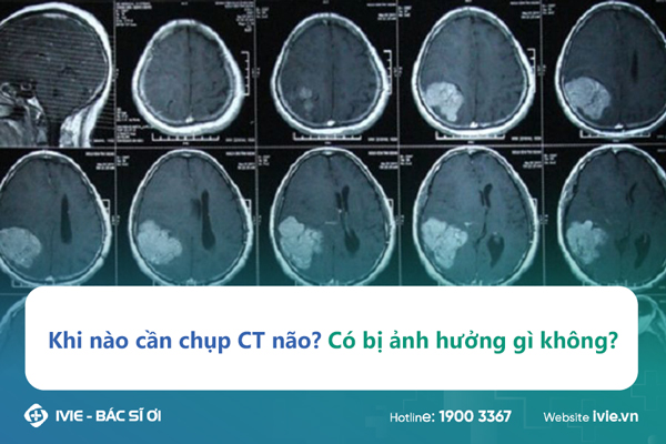 Khi nào cần chụp CT não? Có bị ảnh hưởng gì không?