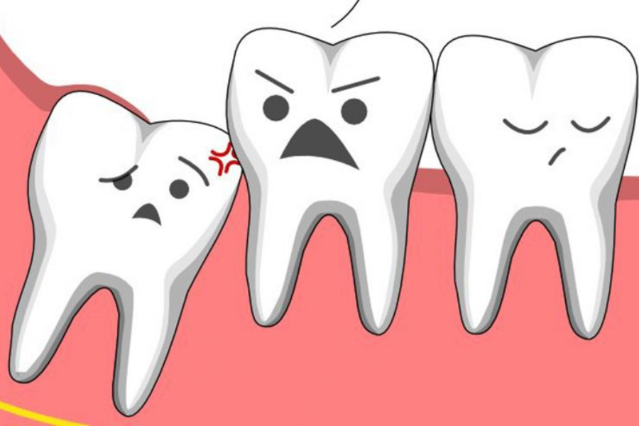 Khi nào bạn cần nhổ răng khôn?