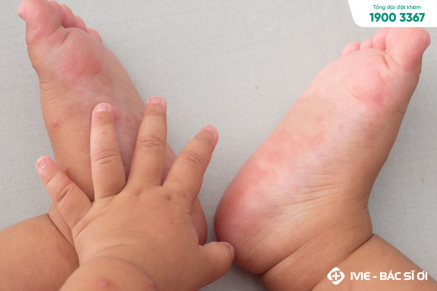 Liệu trẻ bị tay chân miệng có lây cho người khác không?