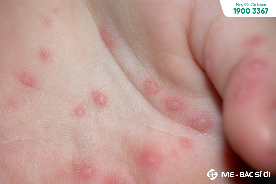 Khi tiếp xúc phải các vết bọng nước trên da cũng có thể bị lây bệnh