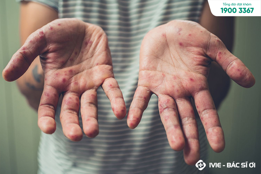 Các dấu hiệu ở người lớn cũng tương tự như ở trẻ em