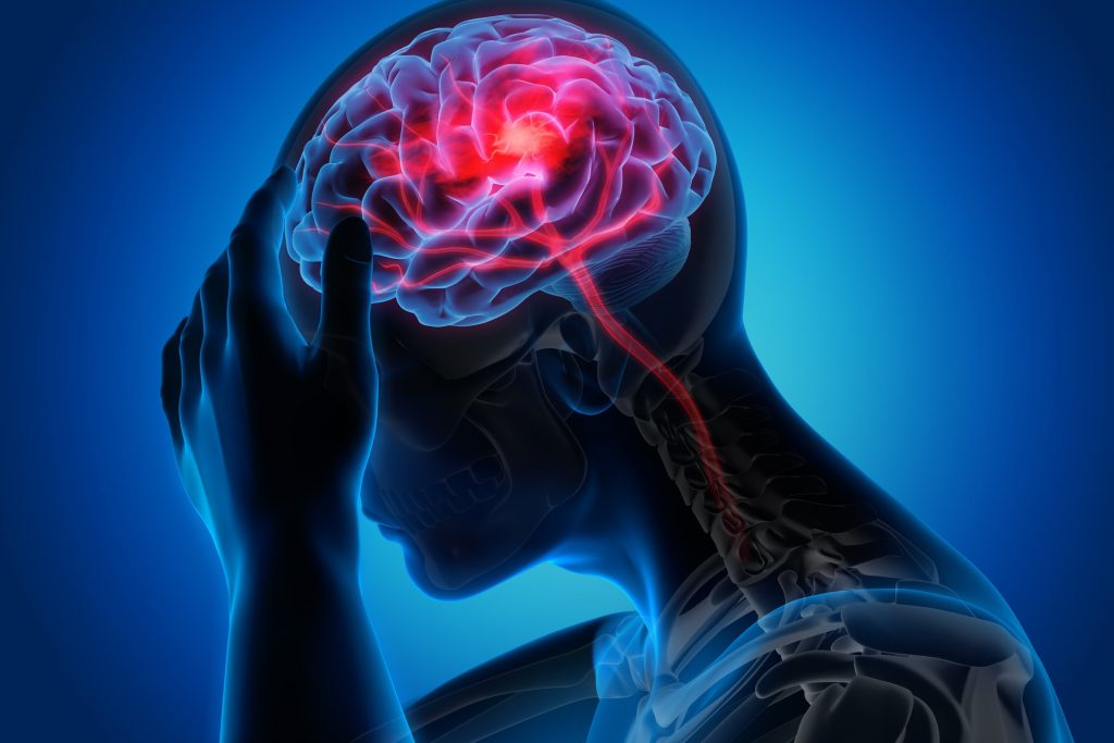 Lao màng não là bệnh cảnh lâm sàng do vi khuẩn lao gây tổn thương ở màng não