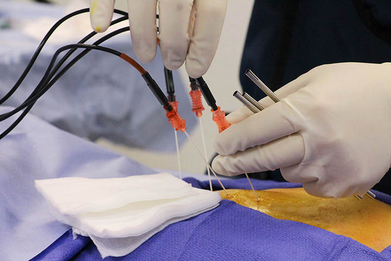 Laser cao tần điều trị thoát vị đĩa đệm tại Phòng Khám Cơ xương khớp Việt Mỹ