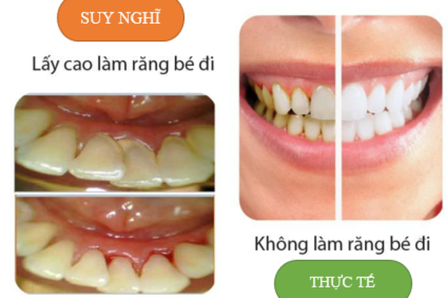 Lấy cao răng là lấy đi phần mảng bám của răng.