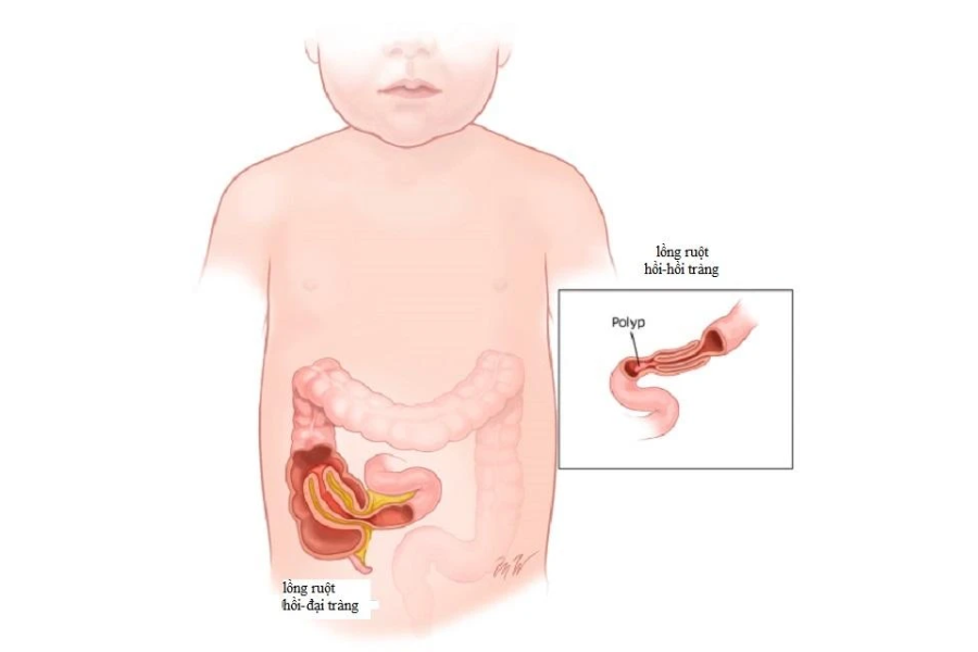 Lồng ruột là cấp cứu bụng ngoại khoa thường gặp ở trẻ em