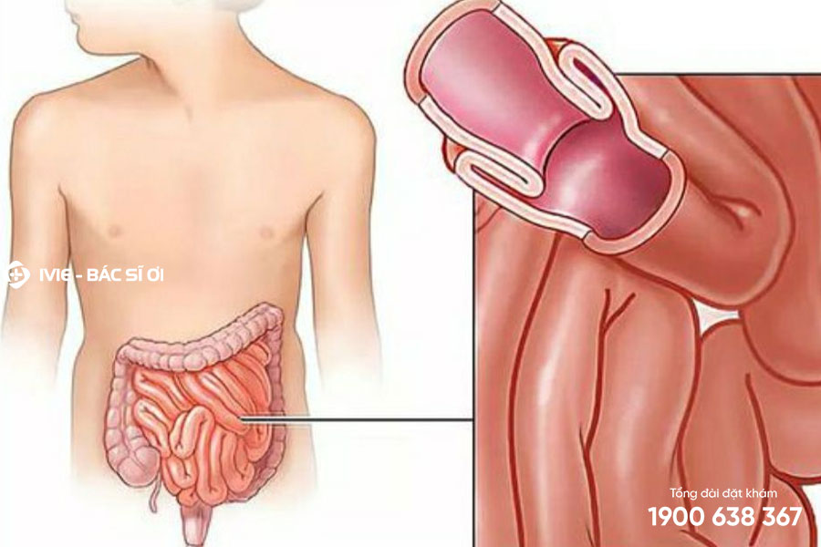 Trẻ đau bụng do lồng ruột cần đưa trẻ đi khám ngay