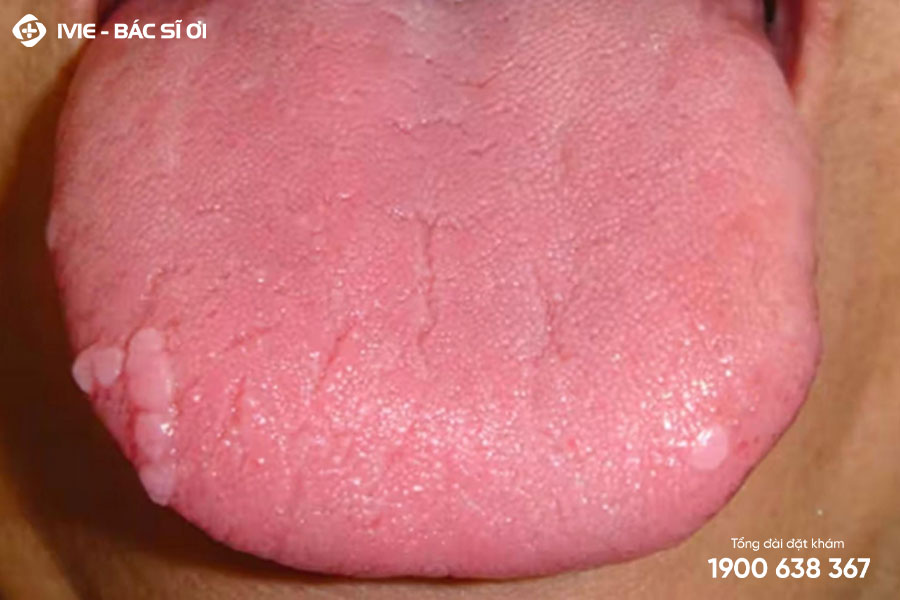 Các nốt trắng có thể mọc ở lưỡi nếu bị virus HPV xâm nhập.