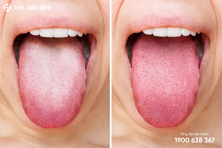 Lưỡi nổi hạt trắng có thể là dấu hiệu của những bệnh lý phức tạp hơn