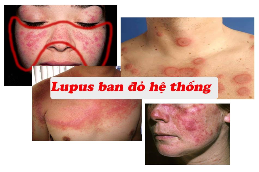 Lupus ban đỏ gây tổn thương đa cơ quan, trong đó có tràn dịch màng ngoài tim