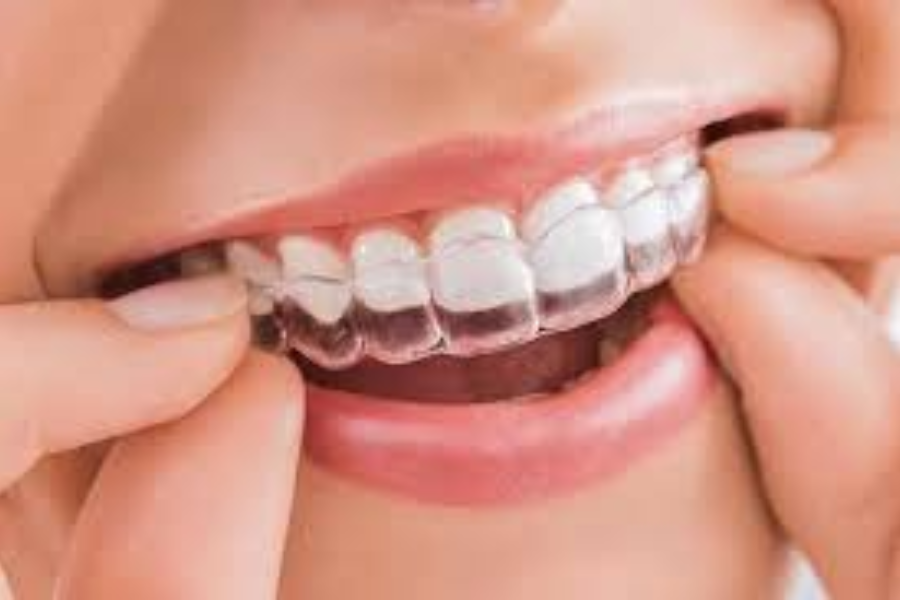 Máng trong suốt duy trì sau chỉnh nha là máng được sản xuất vừa khít với các răng sau kết thúc chỉnh nha