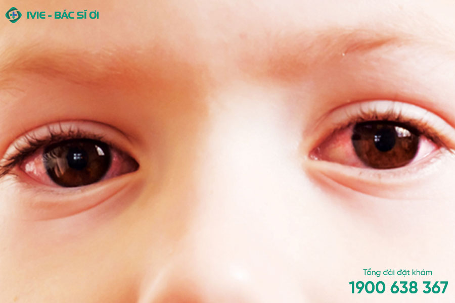 Mắt trẻ bị đỏ lòng trắng là tình trạng rất phổ biến ở trẻ khiến cho nhiều bậc phụ huynh lo lắng
