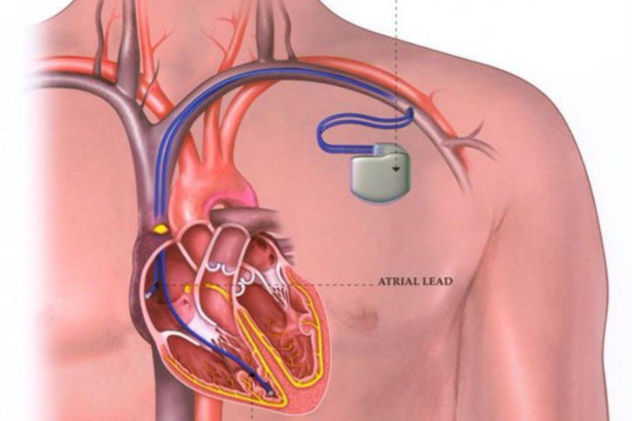 Máy tái đồng bộ cơ tim giúp giảm tỷ lệ nhập viện do suy tim