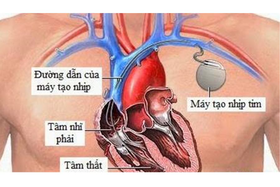 Đặt máy tạo nhịp tim khi có chỉ định giúp cải thiện tình trạng suy tim