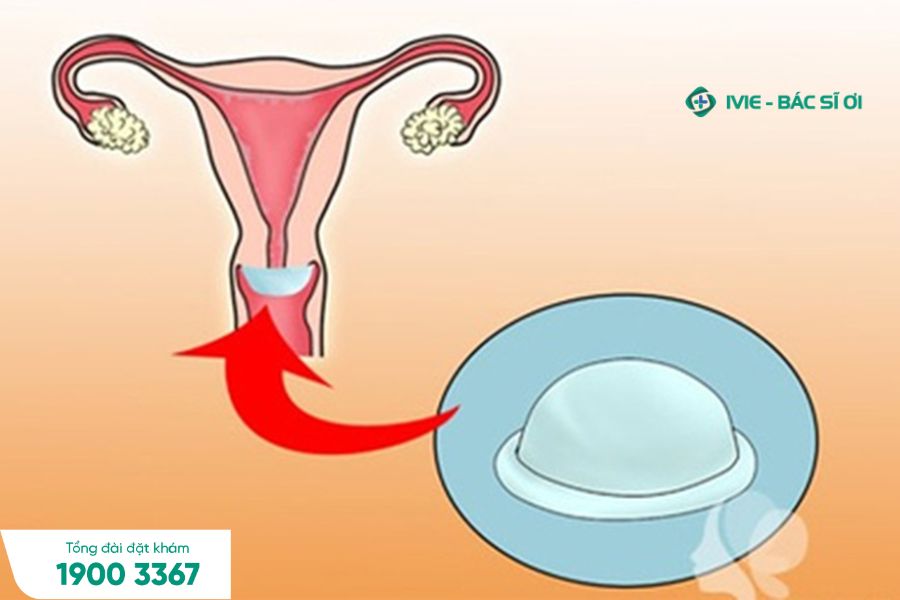 Mũ chụp cổ tử cung để ngăn tinh trùng đi vào tử cung