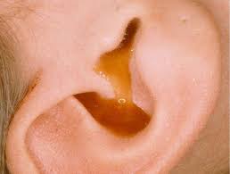 Bố mẹ cần làm gì khi trẻ chảy mủ tai?
