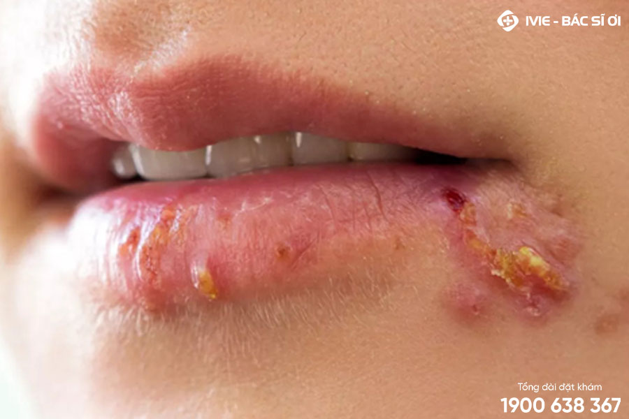 Herpes miệng cũng có thể là bệnh gây nên tình trạng mụn mọc quanh miệng