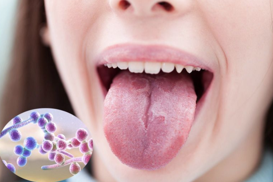 Nấm Candida có thể vào máu từ đường miệng hoặc sinh dục gây viêm nội tâm mạc nhiễm khuẩn