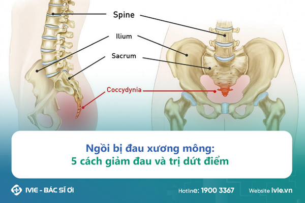 Ngồi bị đau xương mông: 5 cách giảm đau và trị dứt điểm