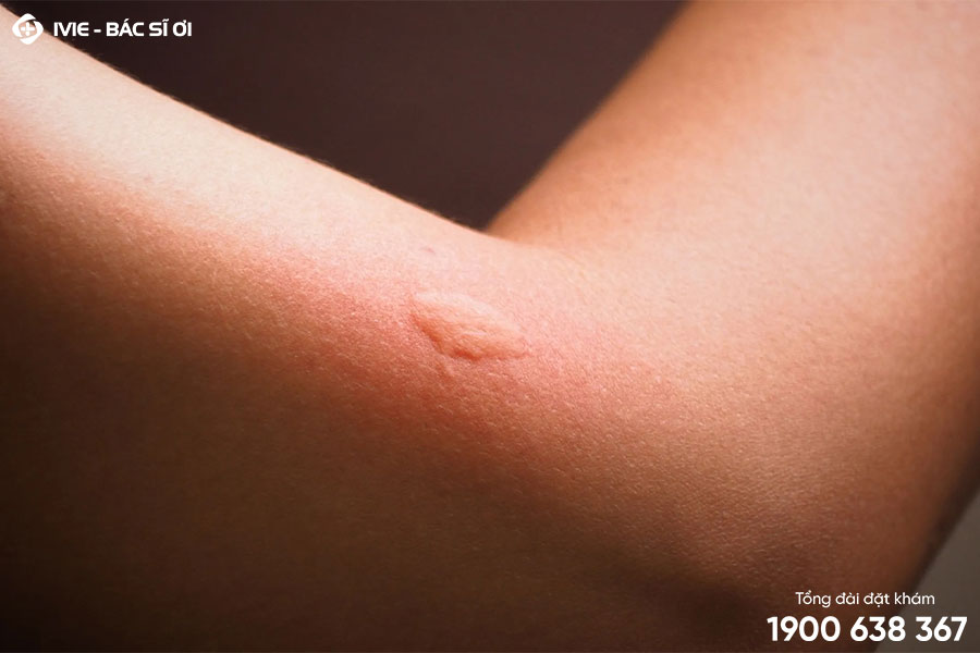 Bị ngứa da vào ban đêm có nguy hiểm không?