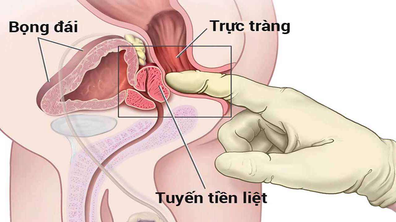 Nguy cơ sau sinh thiết tuyến tiền liệt